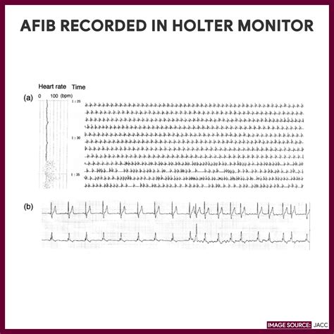 holter monitor results example|Making sense of common Holter ECG findings .